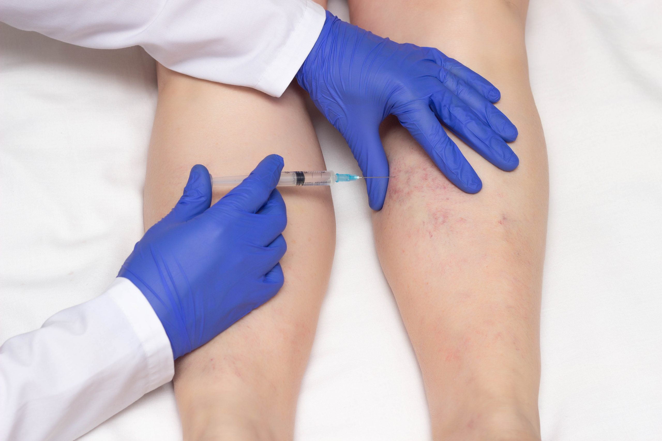 Escleroterapia