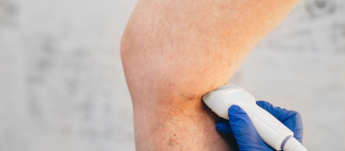 cropped ultrasound exam veins on the leg, vein thrombosis, varicose veins