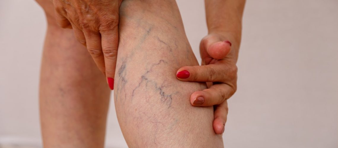 Aplicação de Varizes