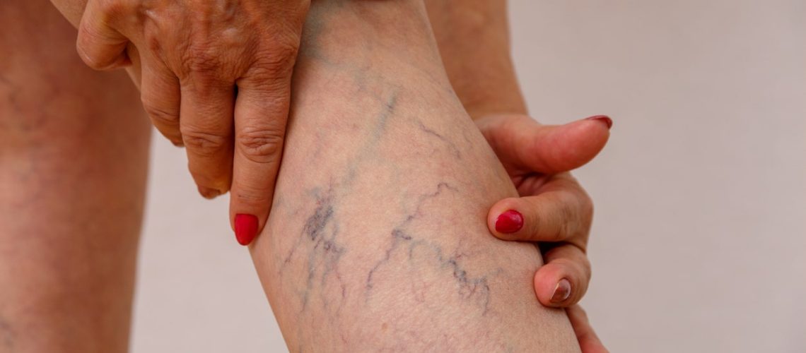 problemas vasculares